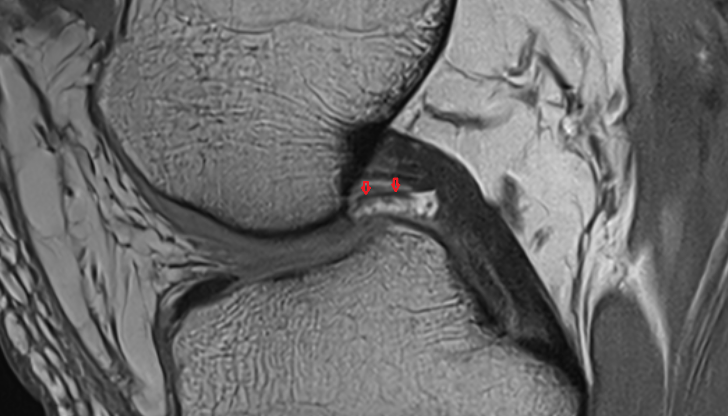 Anterior Meniscofemoral Ligament (Humphrey) sagittall cross sectional anatomy 3T MRI AI enhanced  radiology  anatomy image-img-00000-00000