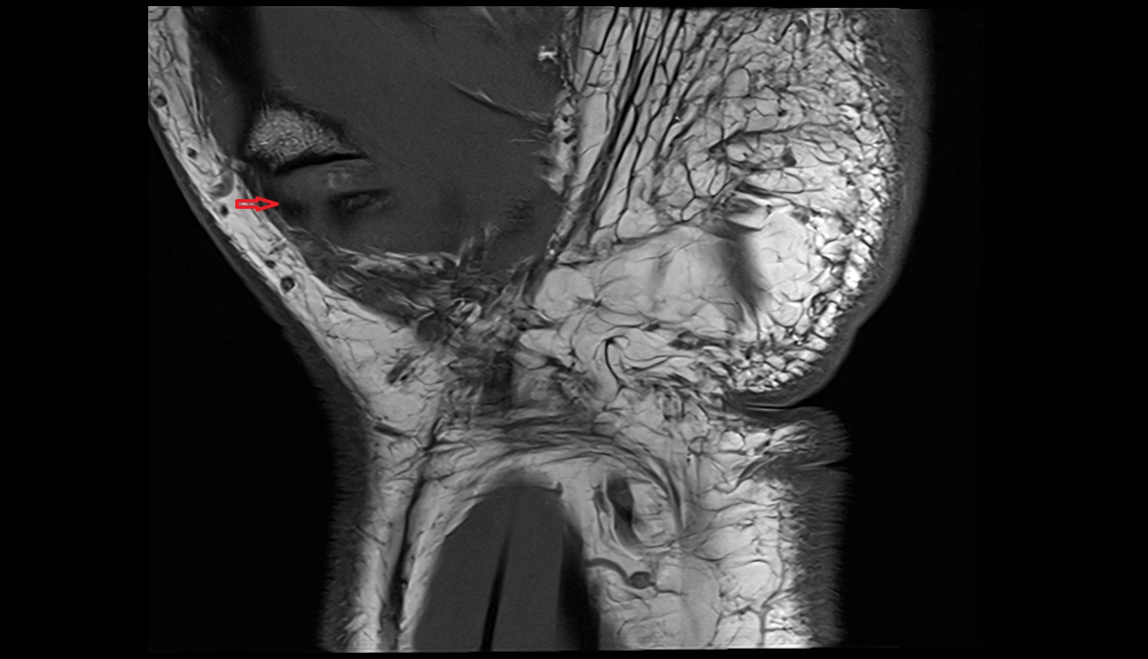 Anterior Oblique (Beak) Ligament CORONAL MRI image