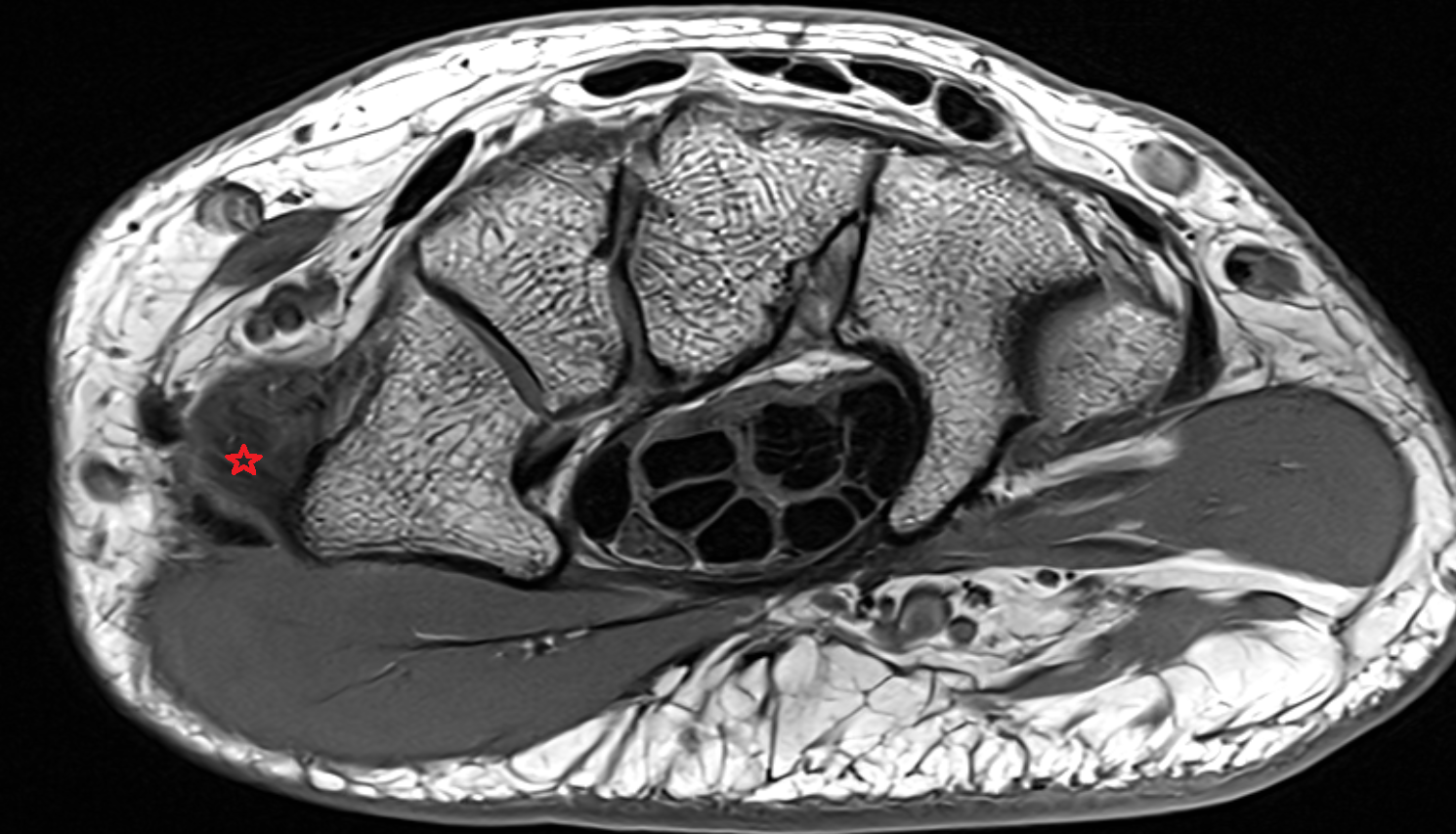 Anterior Oblique (Beak) Ligament  axial cross sectional anatomy 3T MRI AI enhanced radiology image-img-00000-00000