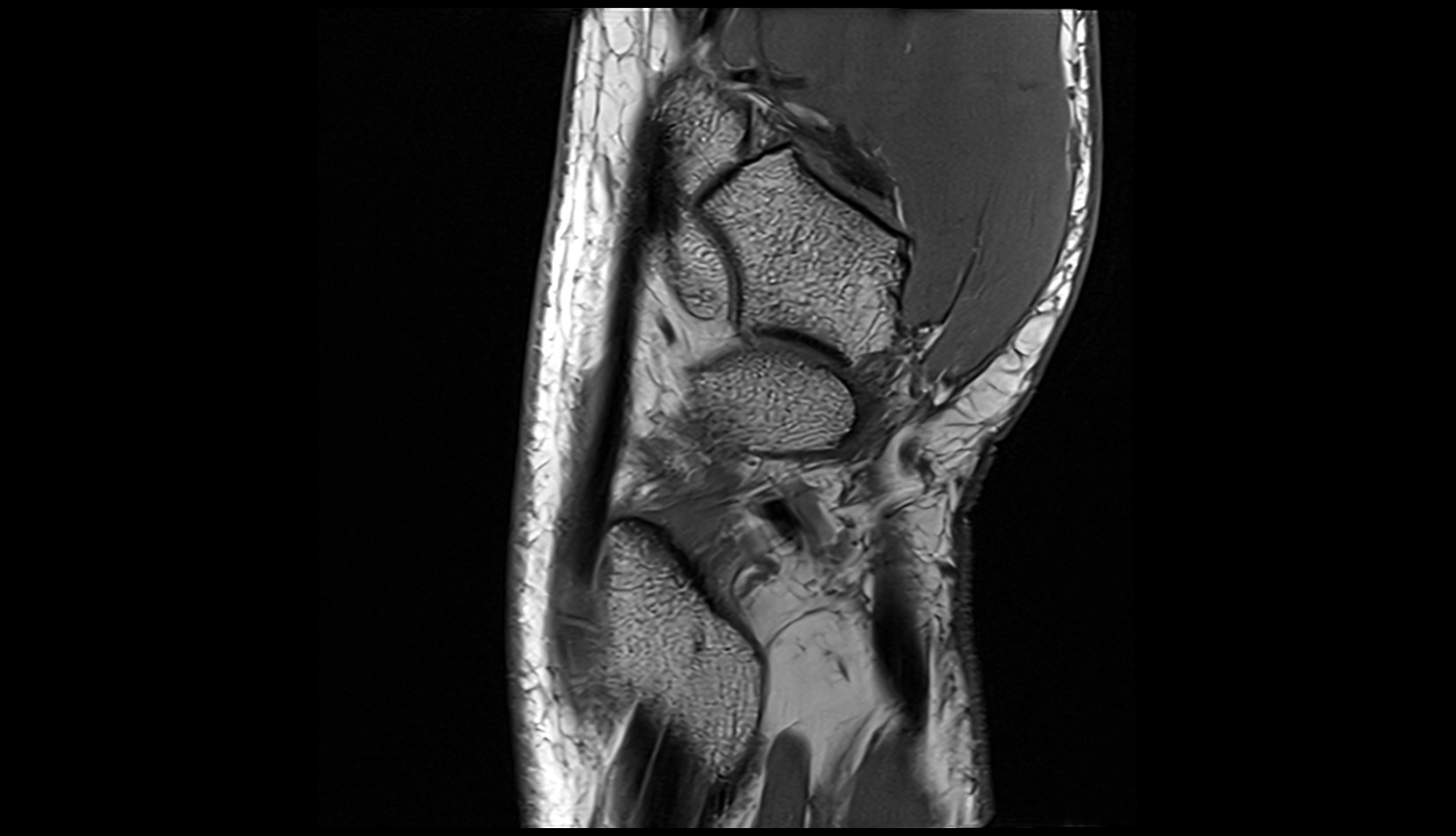Anterior Oblique (Beak) Ligament sag image