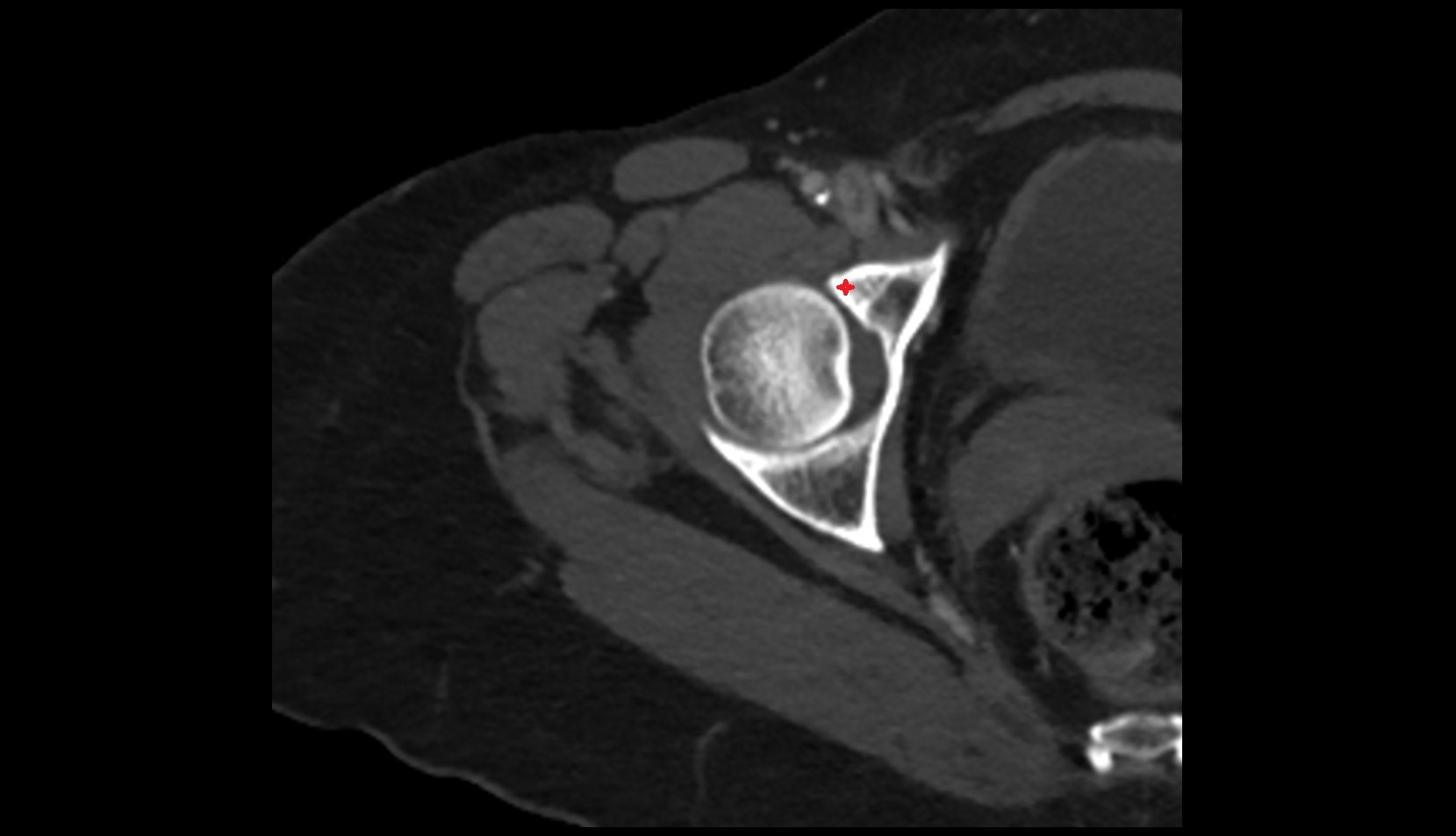 Anterior acetabular wall ct axial image