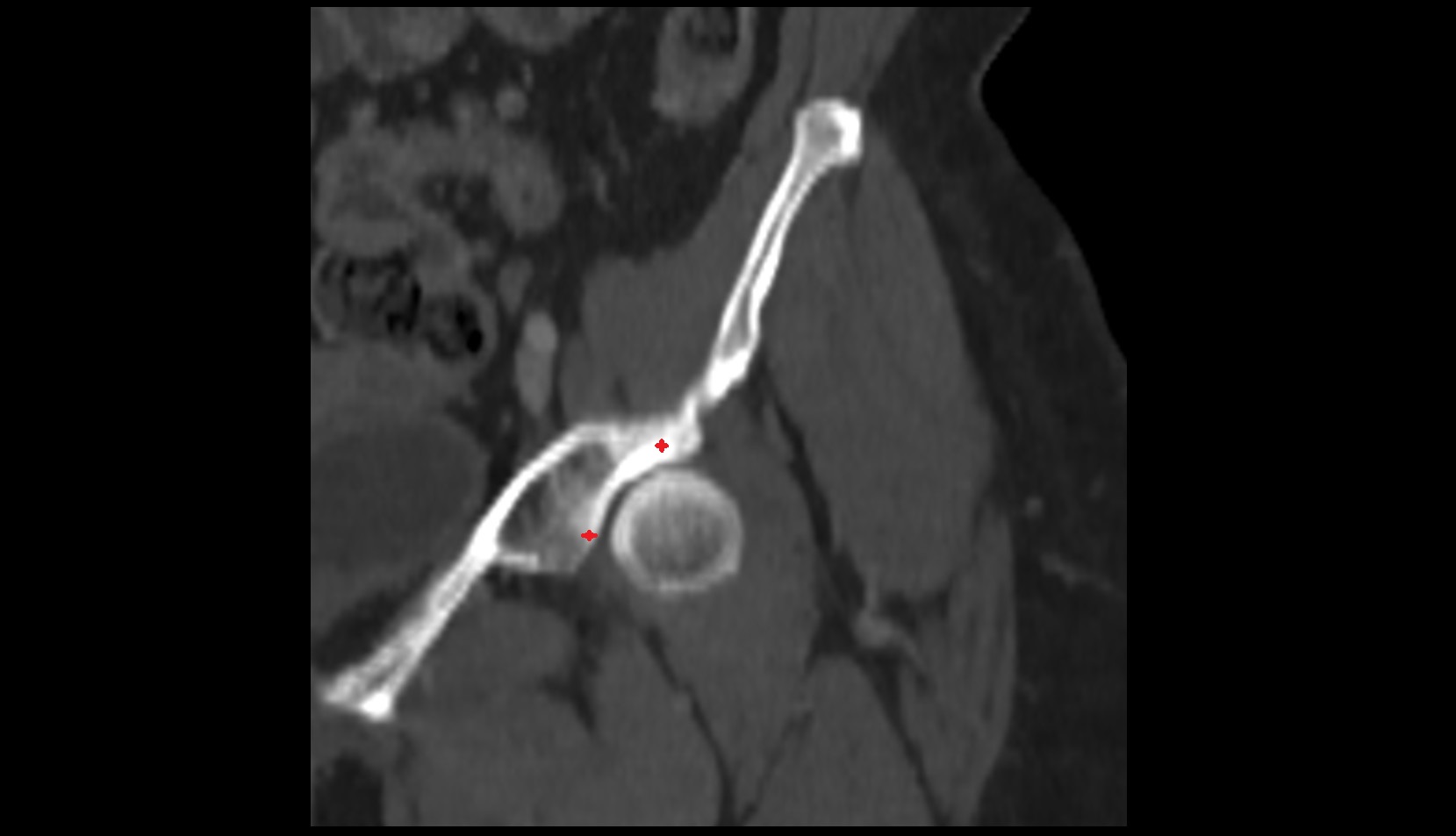 Anterior acetabular wall ct coronal image