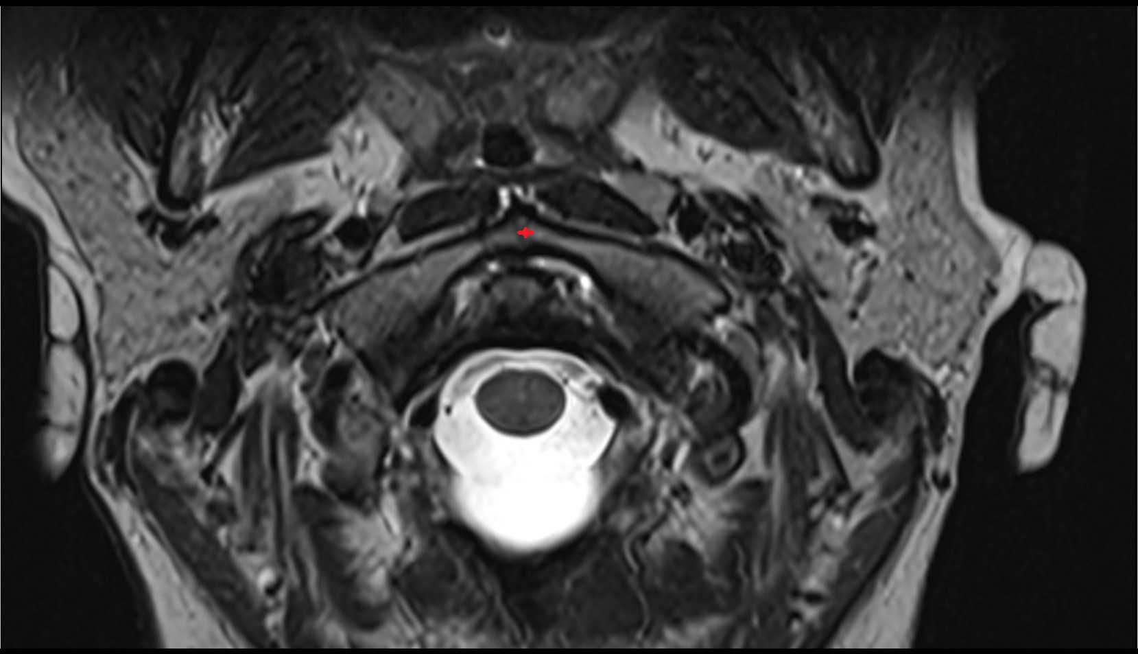Anterior arch of atlas mri axial image