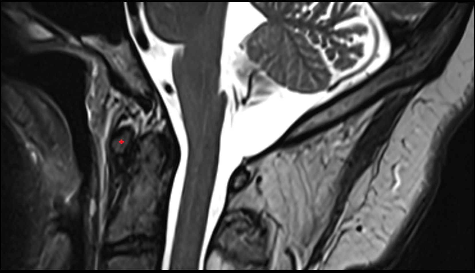 Anterior arch of atlas mri sagittal image