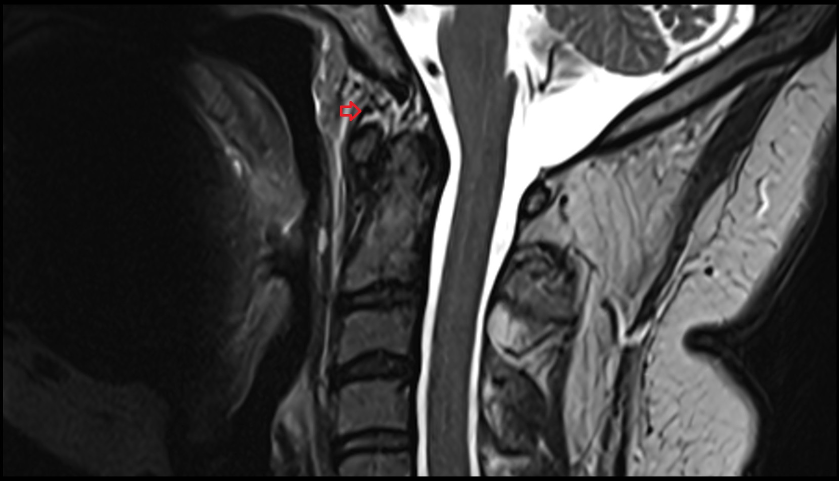 Anterior atlantooccipital membrane mri sagittal image