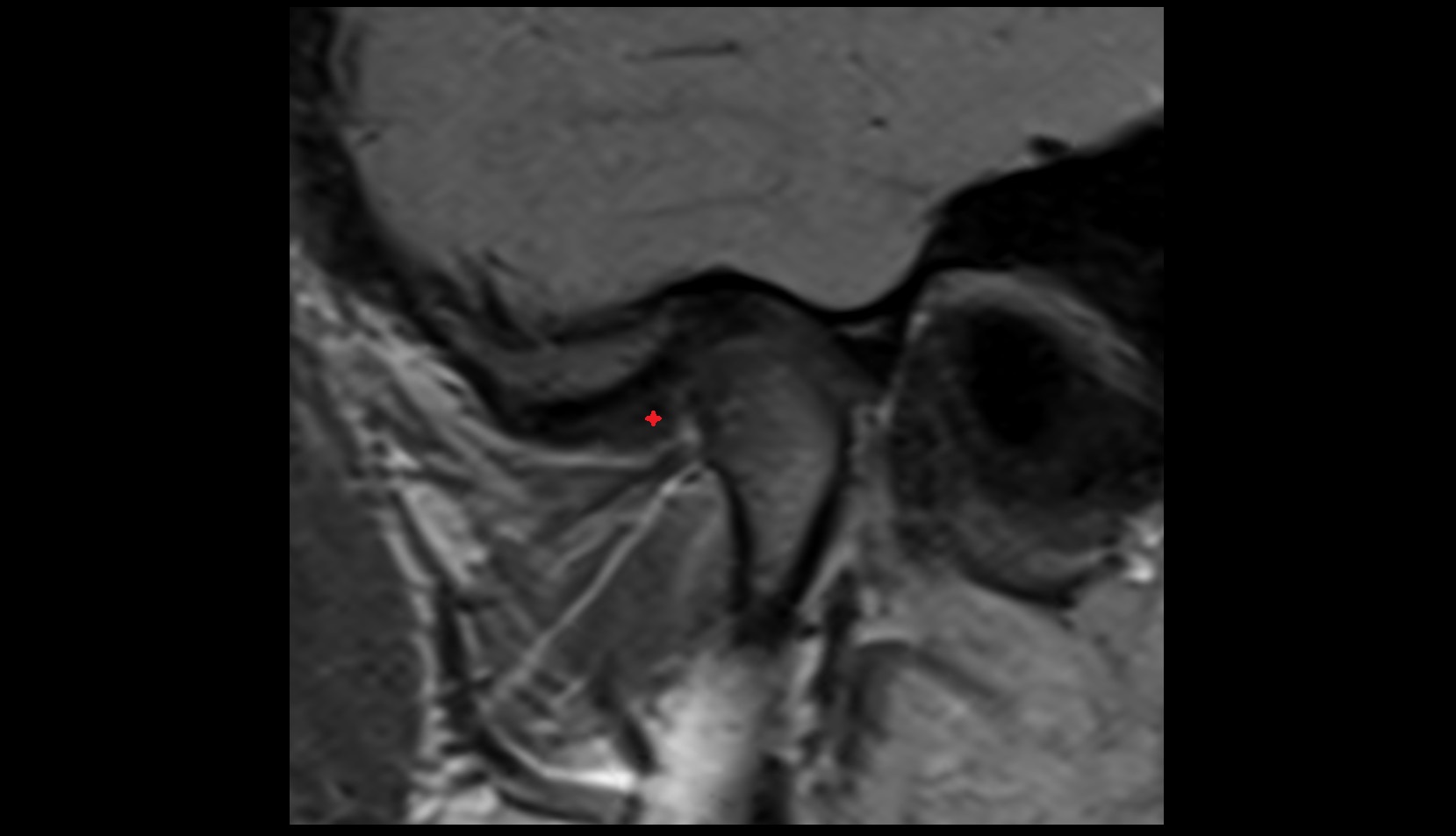 Anterior band of articular disc