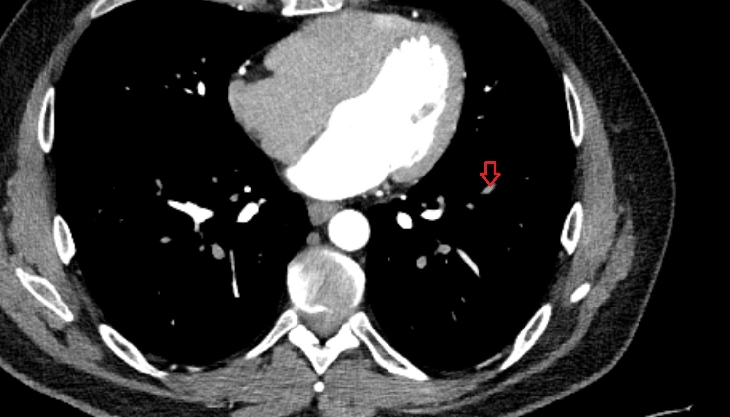 Anterior basal segmental artery of left lung anatomy CT axial  image -img-00000-00000