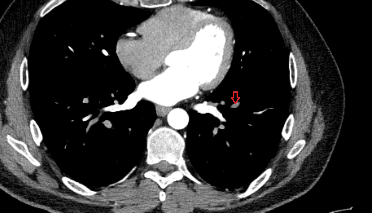 Anterior basal segmental artery of left lung anatomy CT axial  image -img-00000-00000_00001