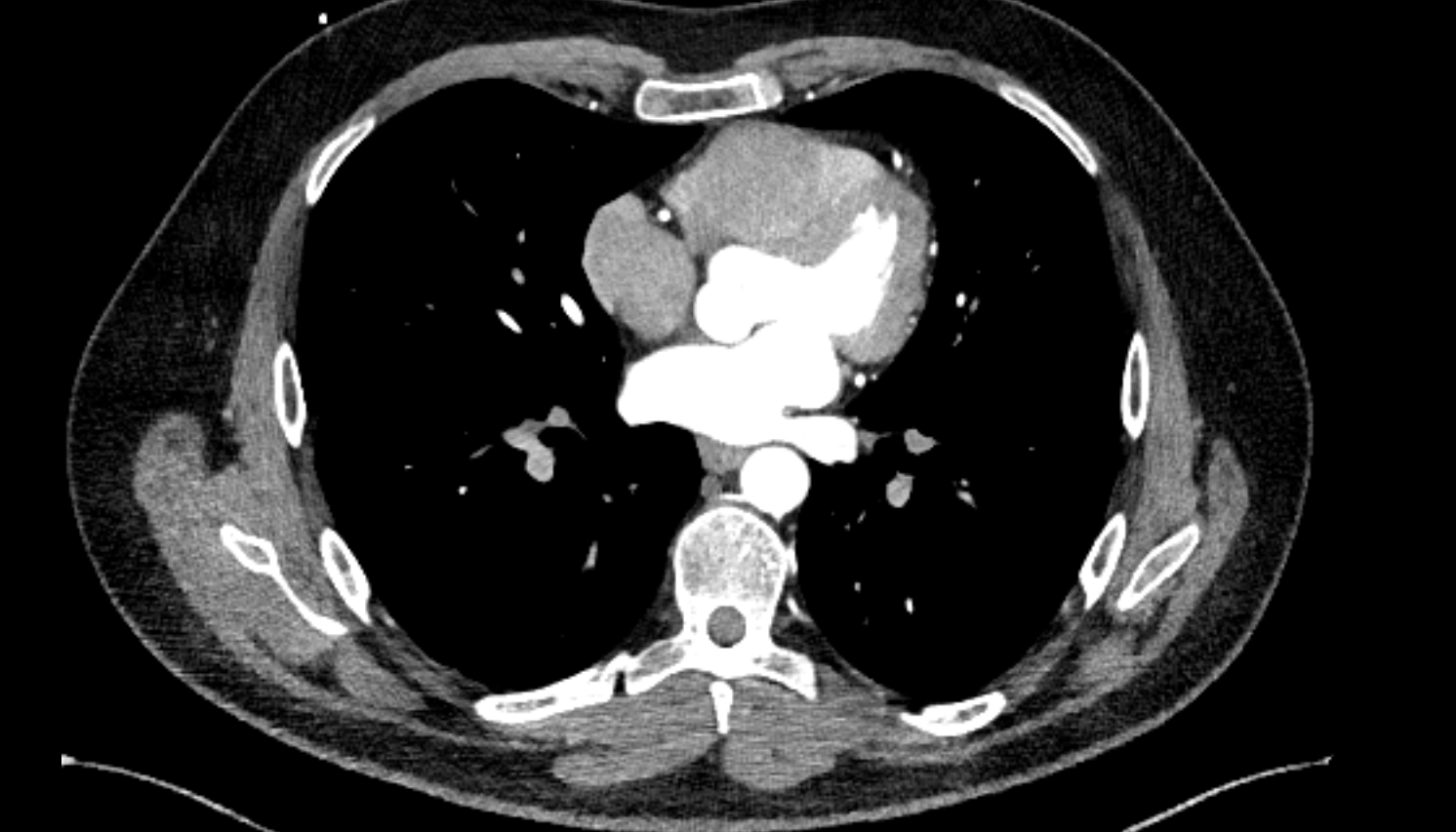 Anterior basal segmental artery of right lung  anatomy CT axial  image -img-00000-00000