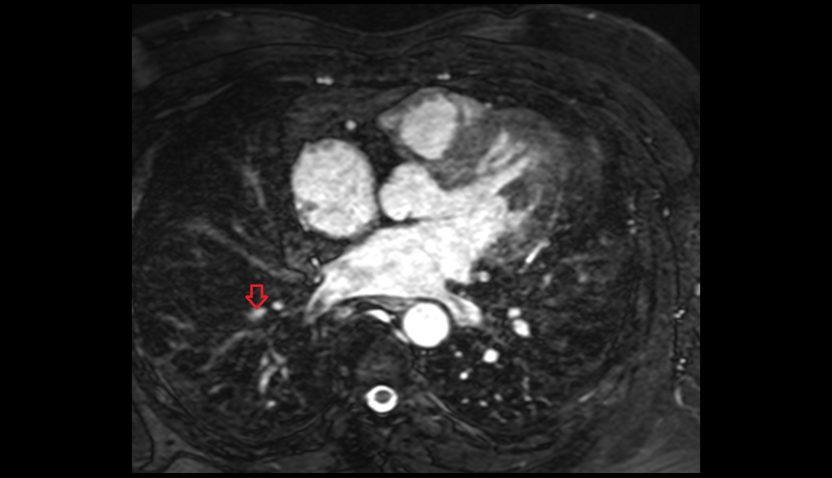 Anterior basal segmental artery of right lung mri image