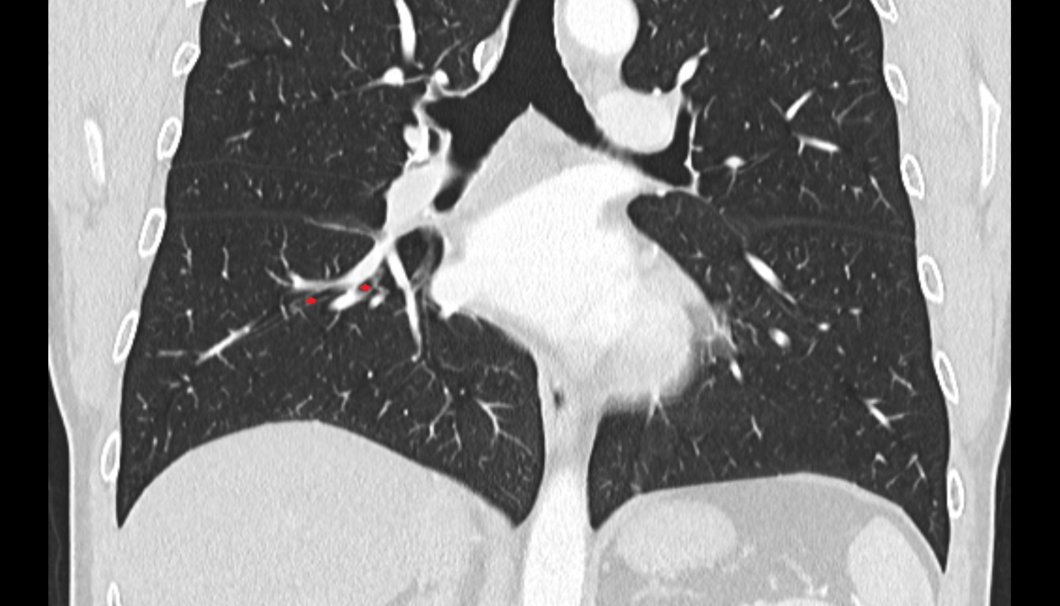 Anterior basal segmental bronchus of right lung (B7+8, B8)  anatomy  CT coronal  image -img-00000-00000