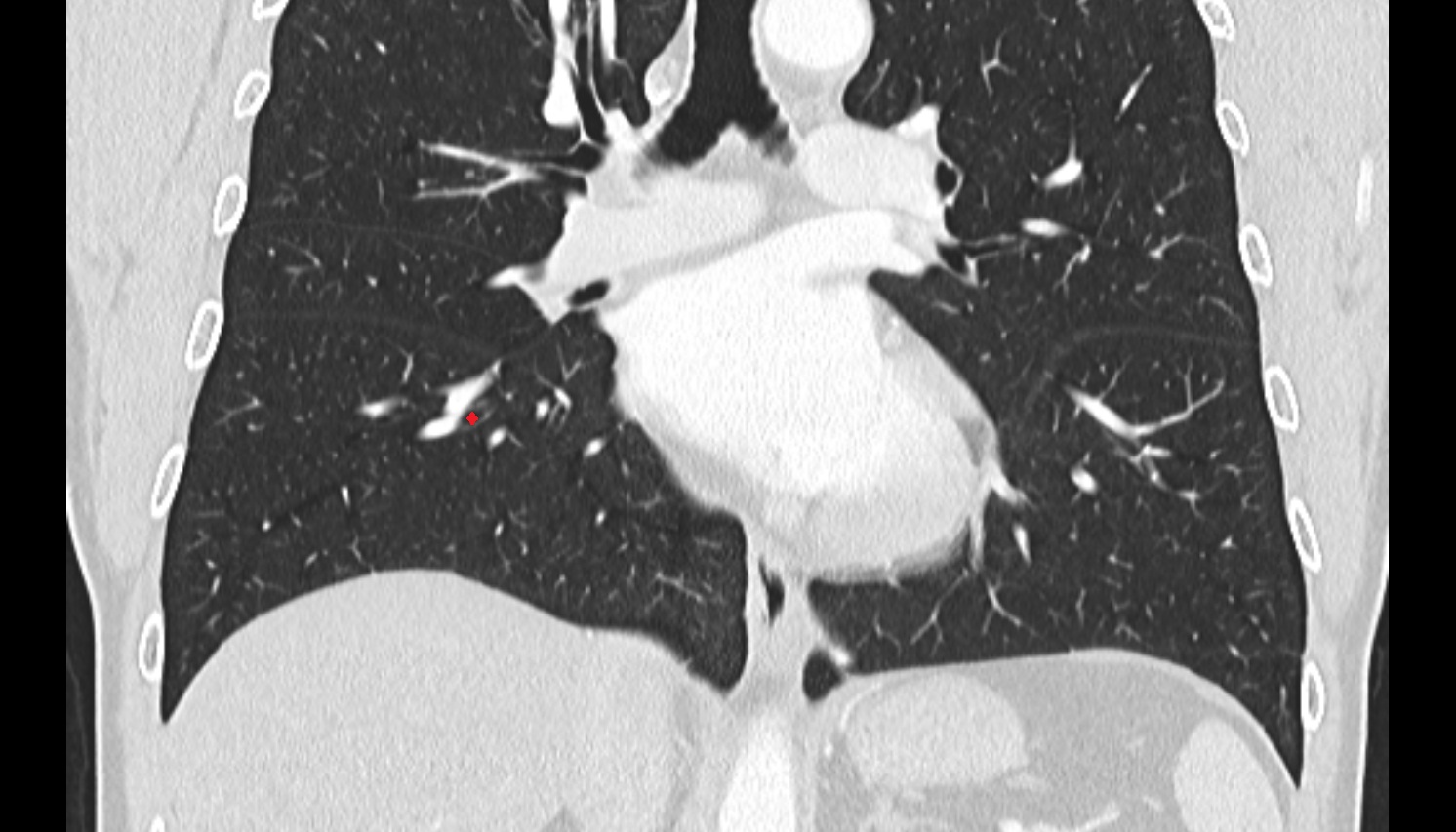 Anterior basal segmental bronchus of right lung (B7+8, B8)  anatomy  CT coronal  image -img-00000-00000_00001