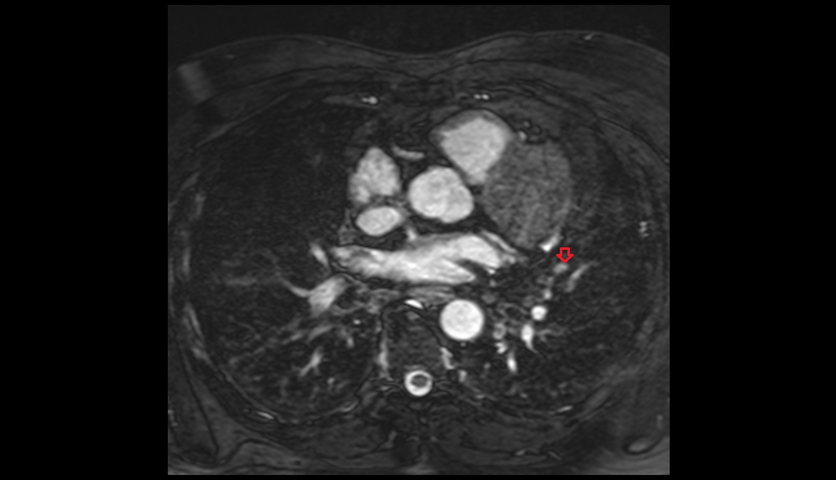 Anterior basal vein of left lung MRI IMAGE