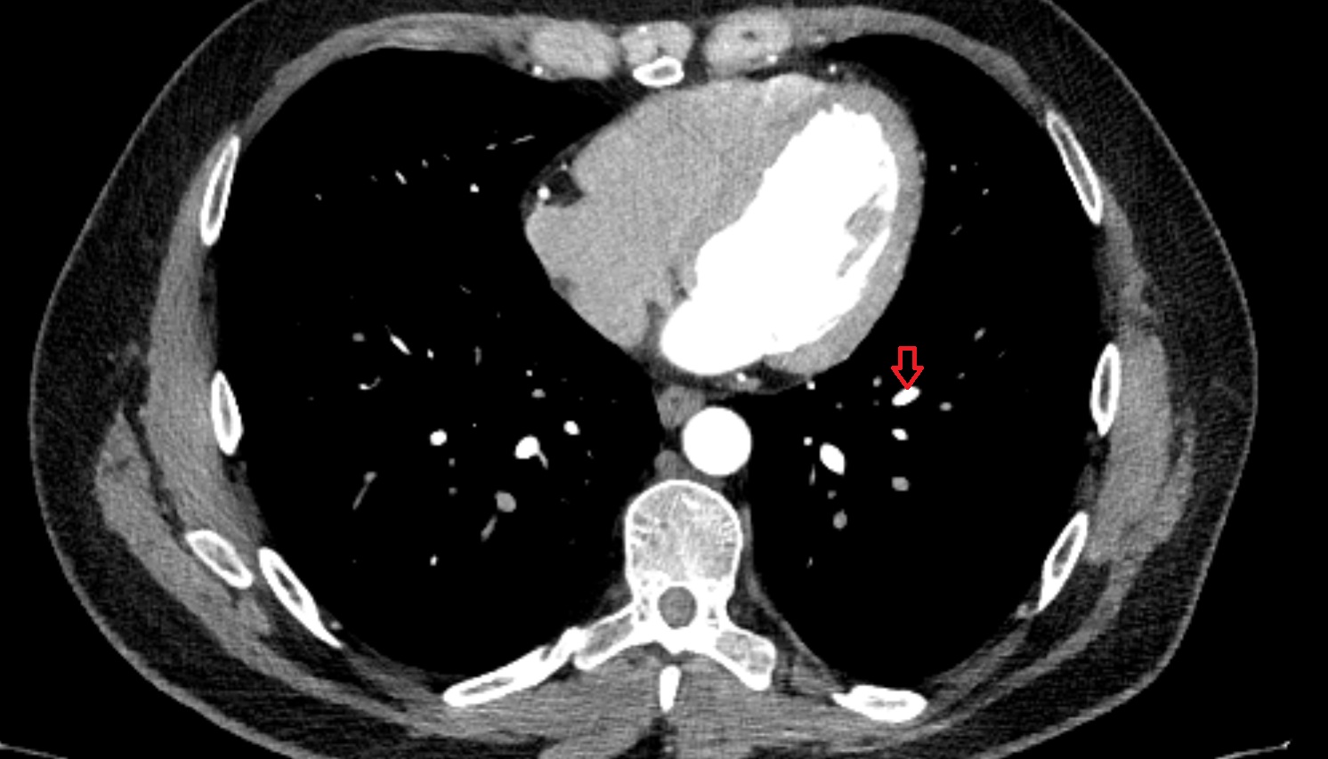 Anterior basal vein of left lung  anatomy CT axial  image -img-00000-00000