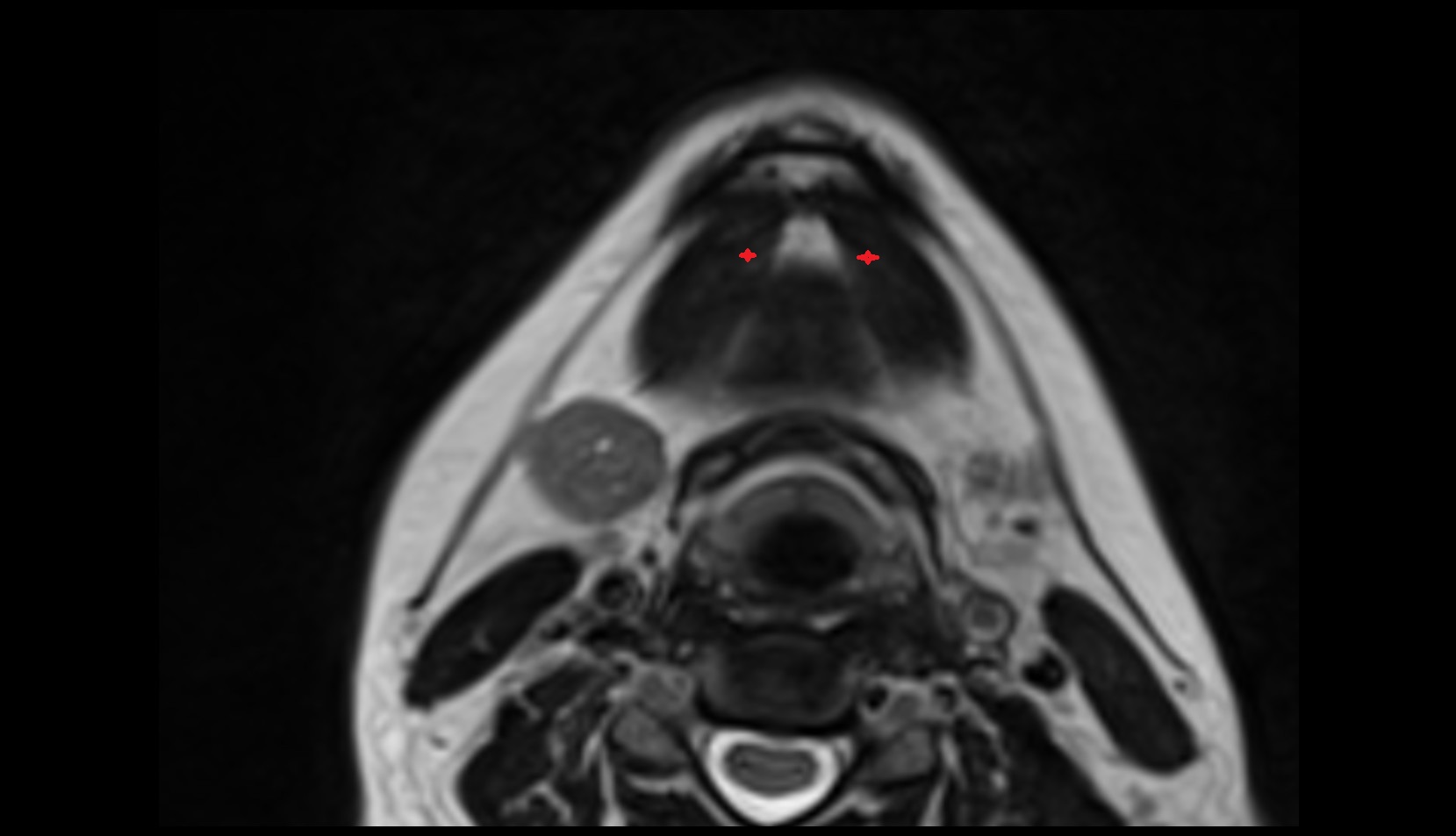 Anterior belly  of digastric muscle