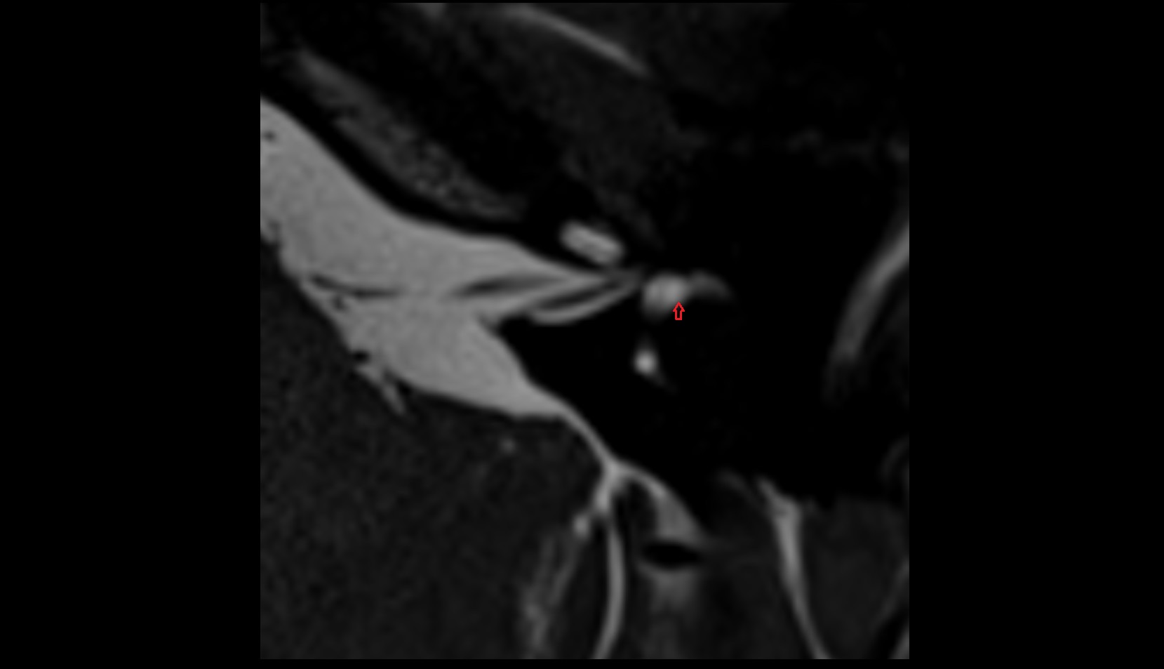 Anterior bony ampulla mri axial image