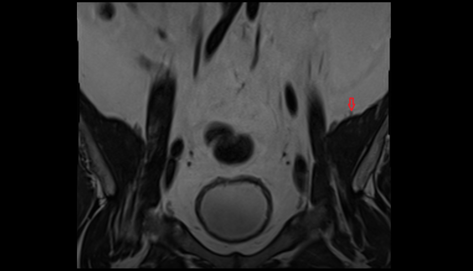 Anterior branch lateral femoral cutaneous nerve