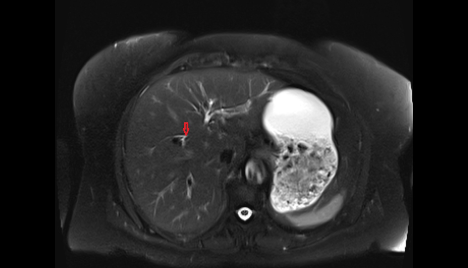 Anterior branch of right hepatic duct  mri  coronal  anatomy  image-img-00000-00000