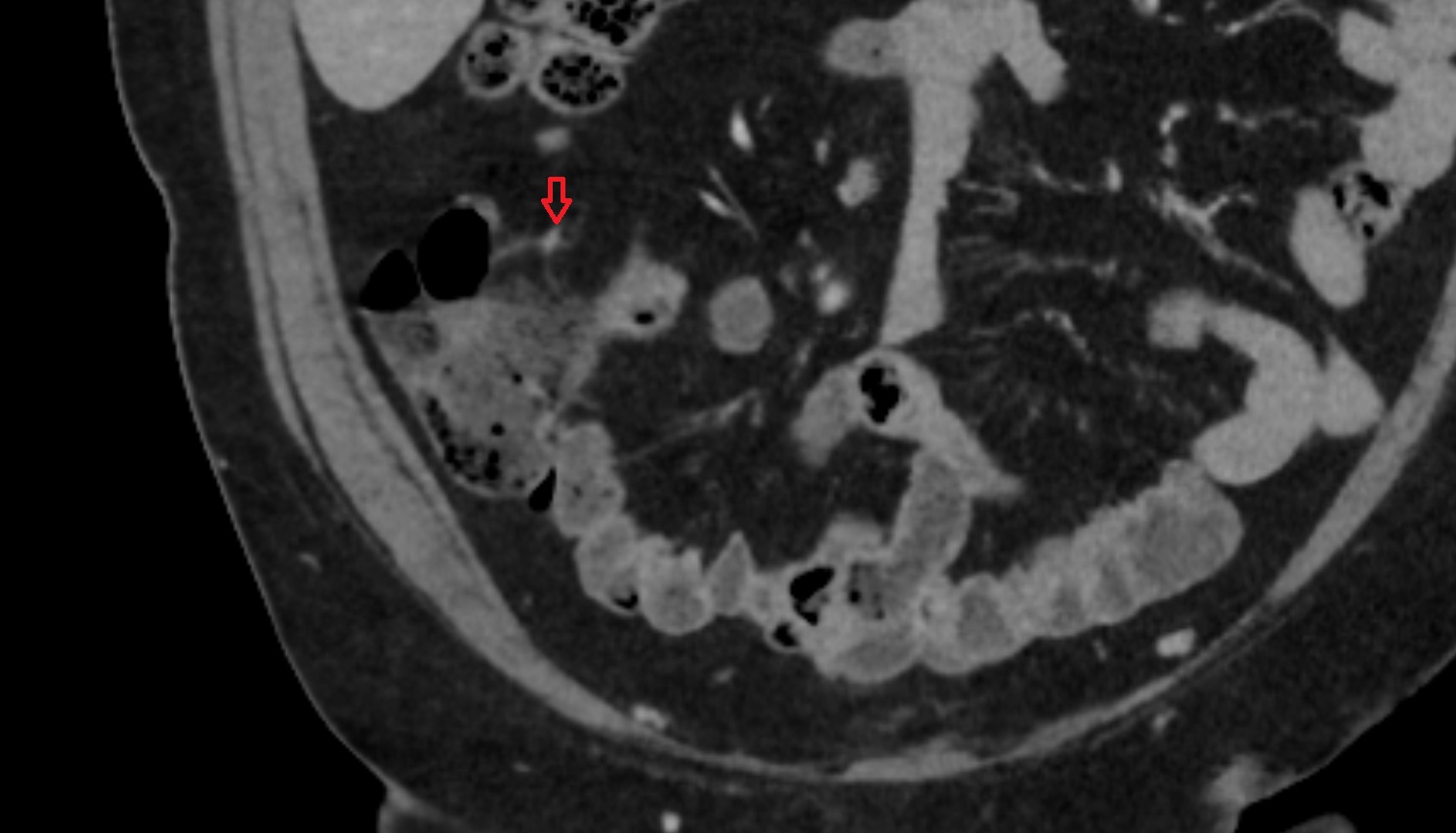 Anterior cecal artery CT axial anatomy  image -img-00000-00000