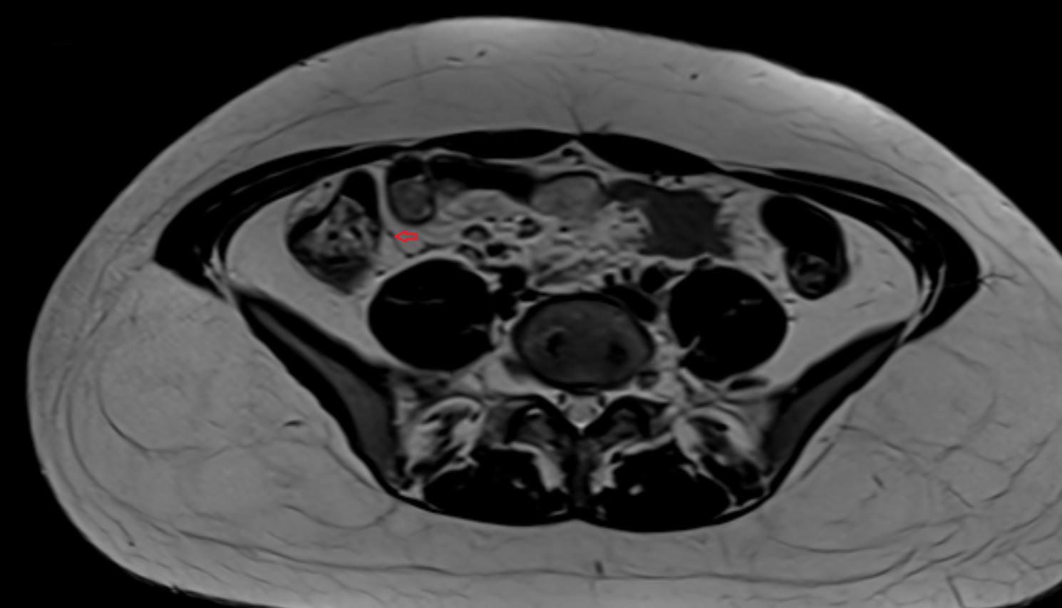 Anterior cecal artery  MRI coronal  image-img-00000-00000