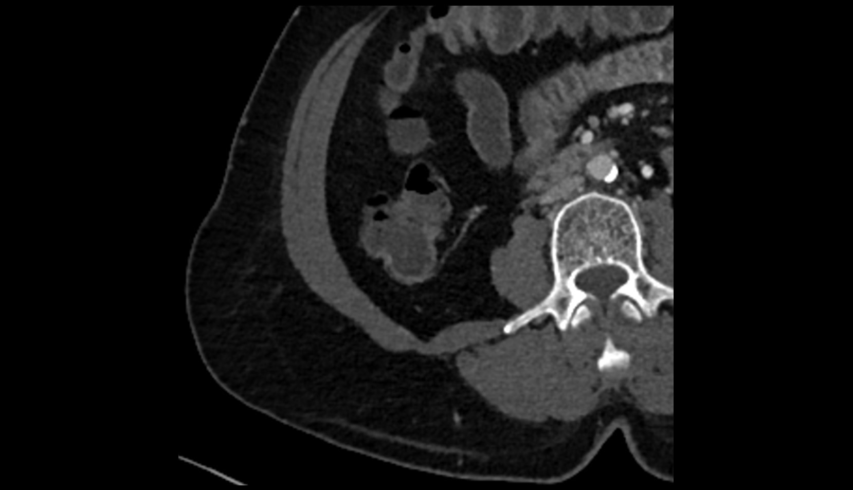 Anterior cecal artery ct axial image