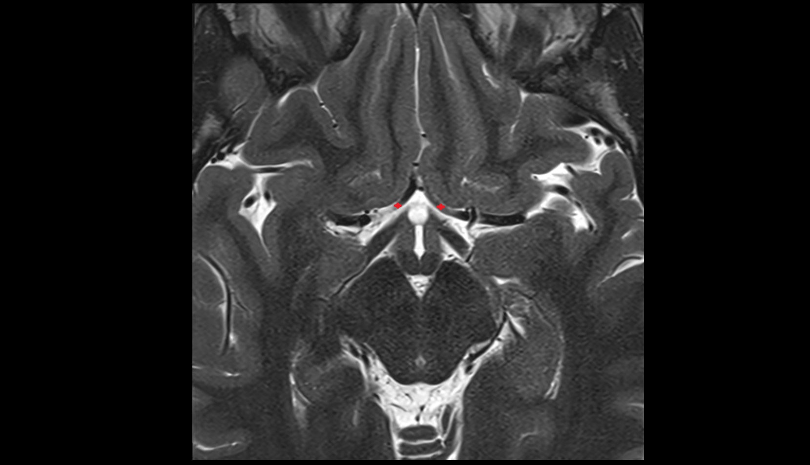 Anterior cerebral artery (A1 Segment)