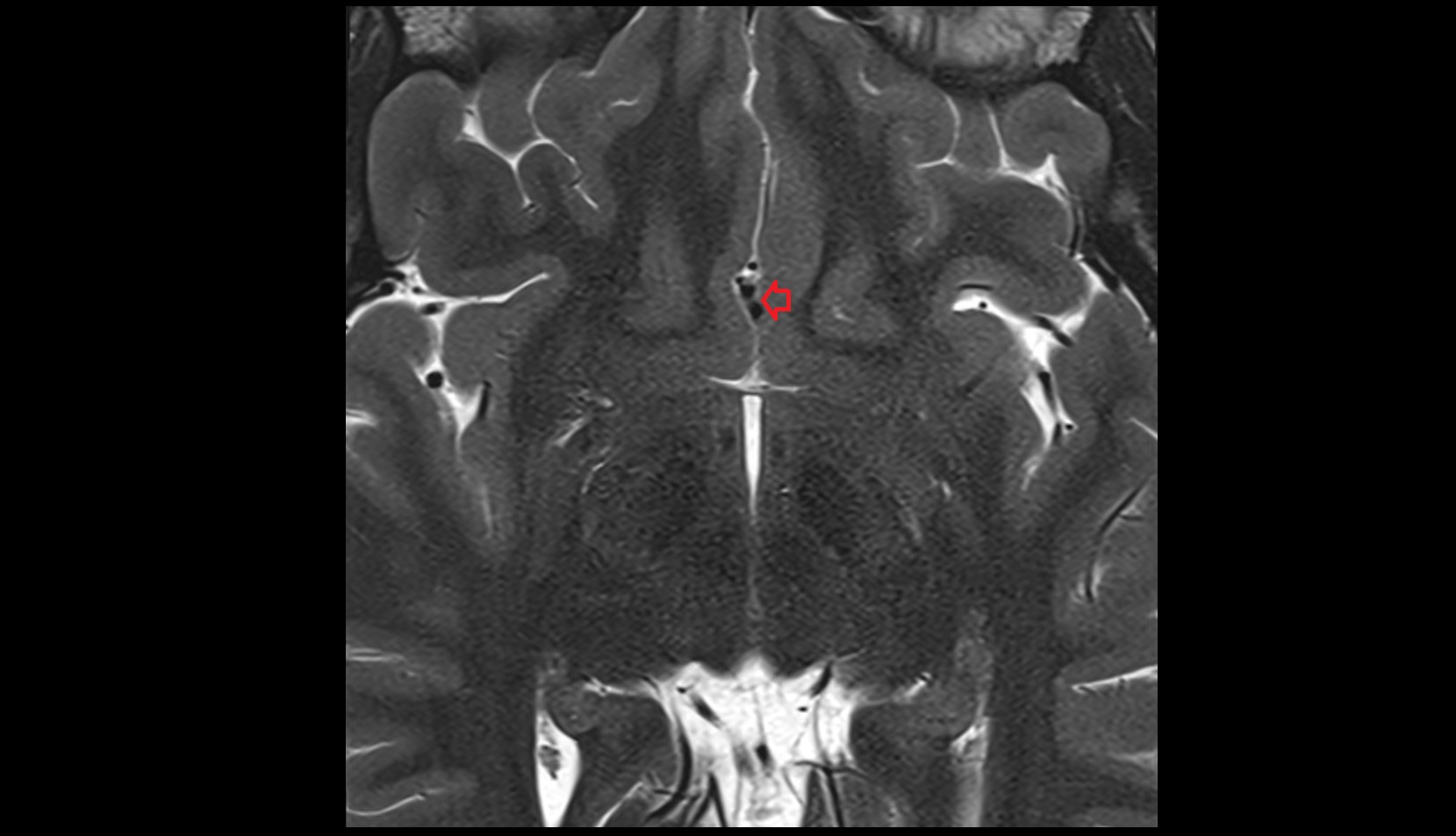 Anterior cerebral artery (A2 Segment) mri axial image