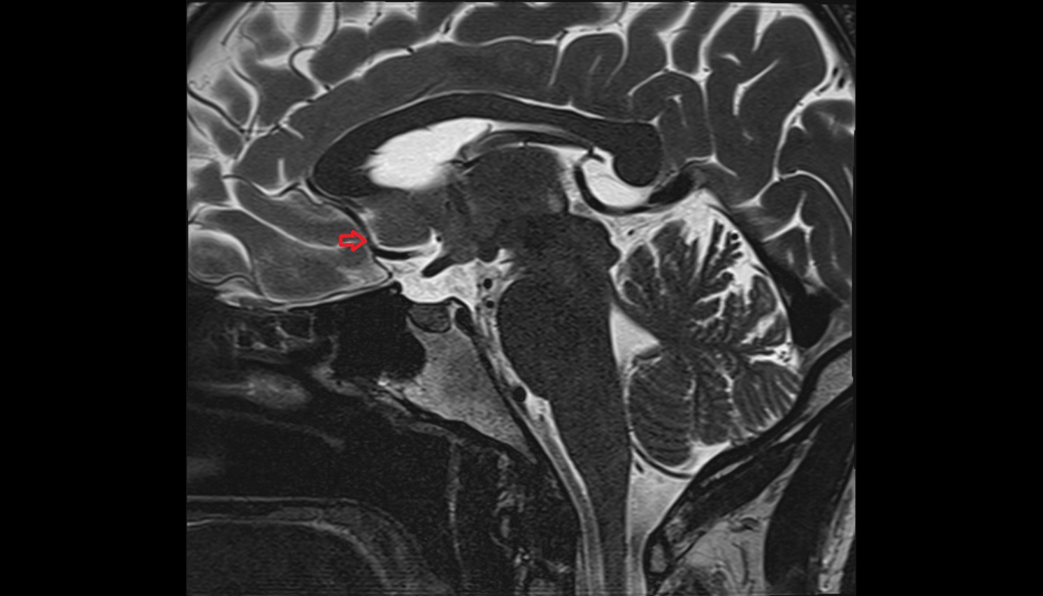 Anterior cerebral artery (A2 Segment) mri sagittal  image -img-00000-00000