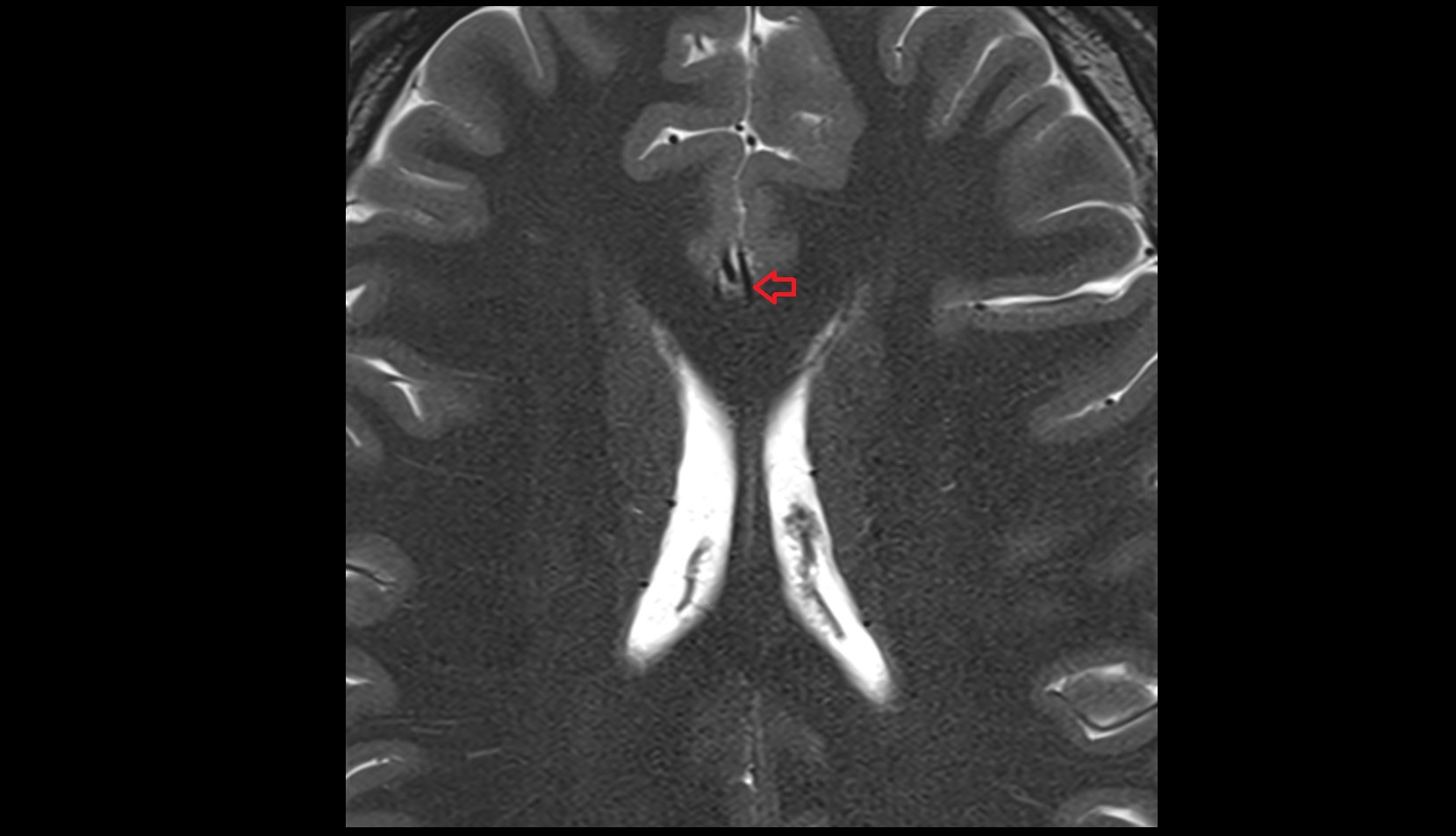 Anterior cerebral artery (A3 Segment)