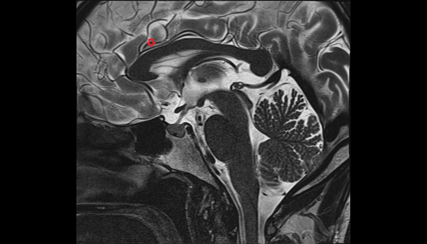 Anterior cerebral artery (A3 Segment) mri sagittal  image -img-00000-00000