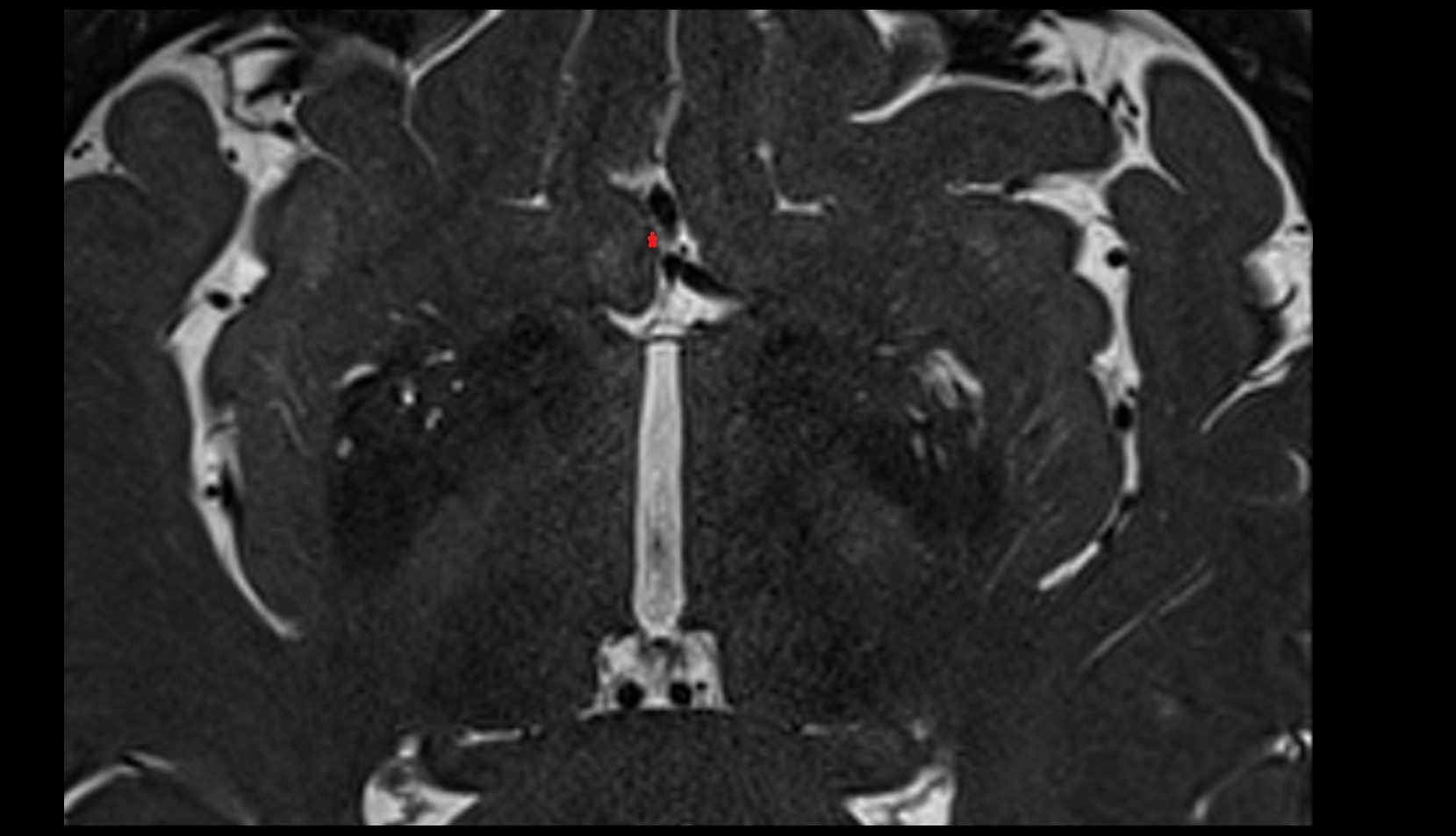 Anterior cerebral veins MRI 3T axial image