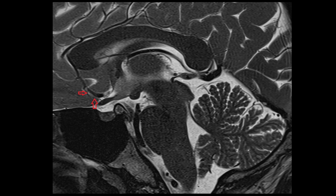 Anterior cerebral veins mri 3t sagittal image