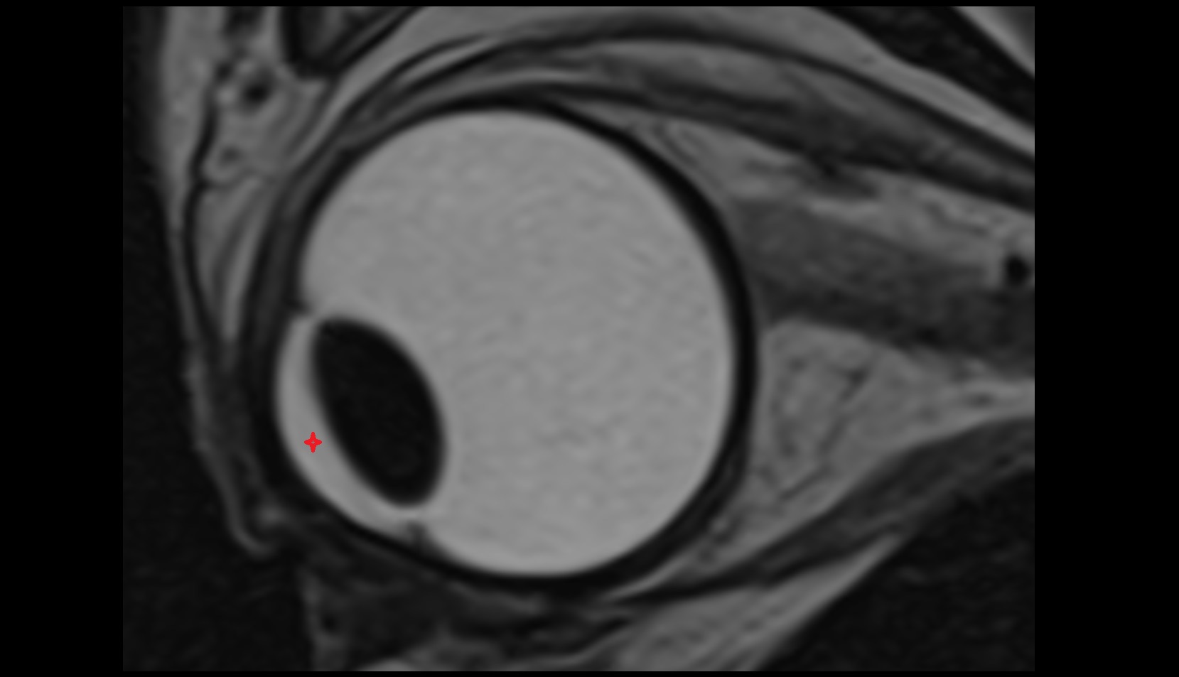 Anterior chamber of eyeball mri image