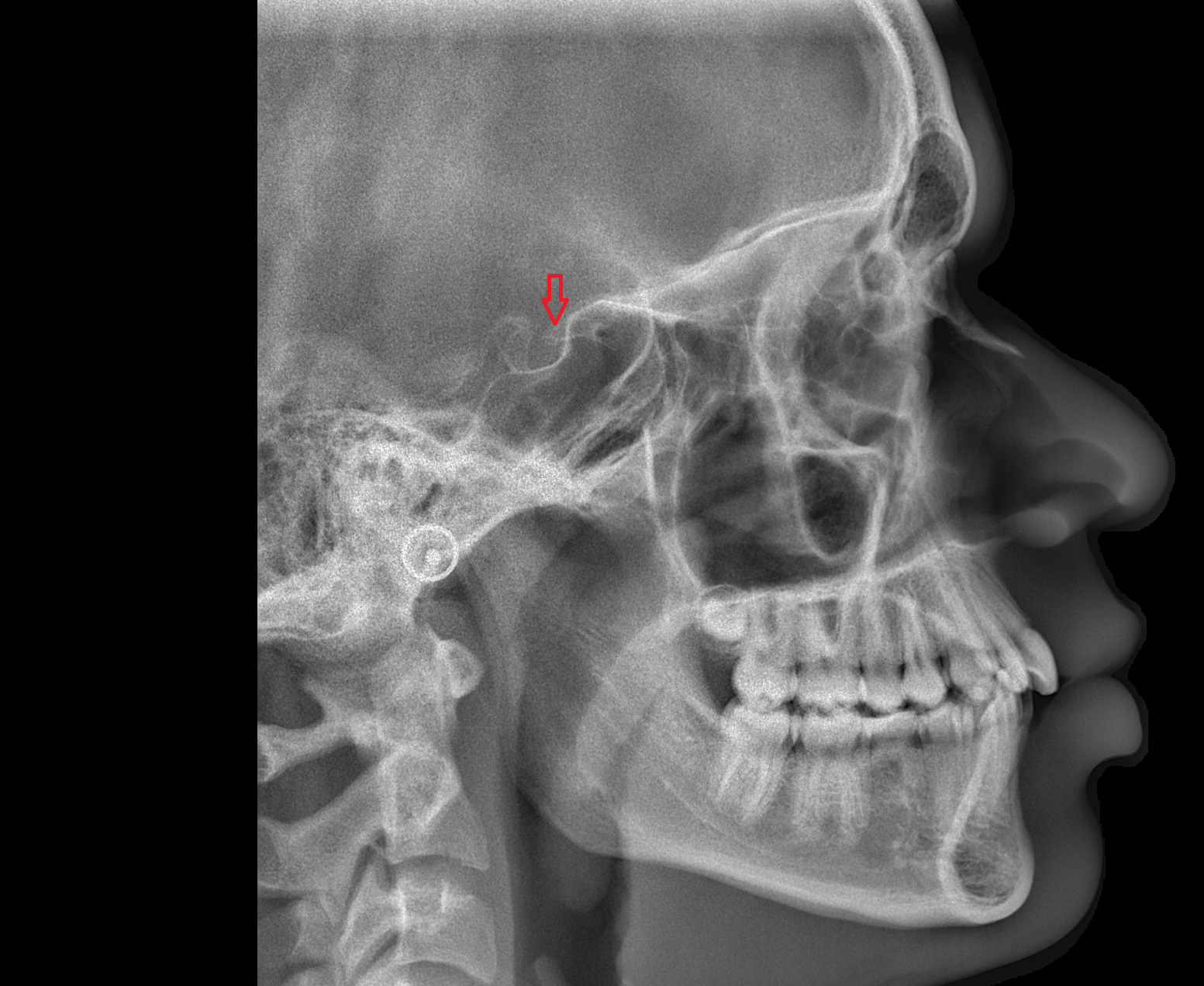 Anterior clinoid process