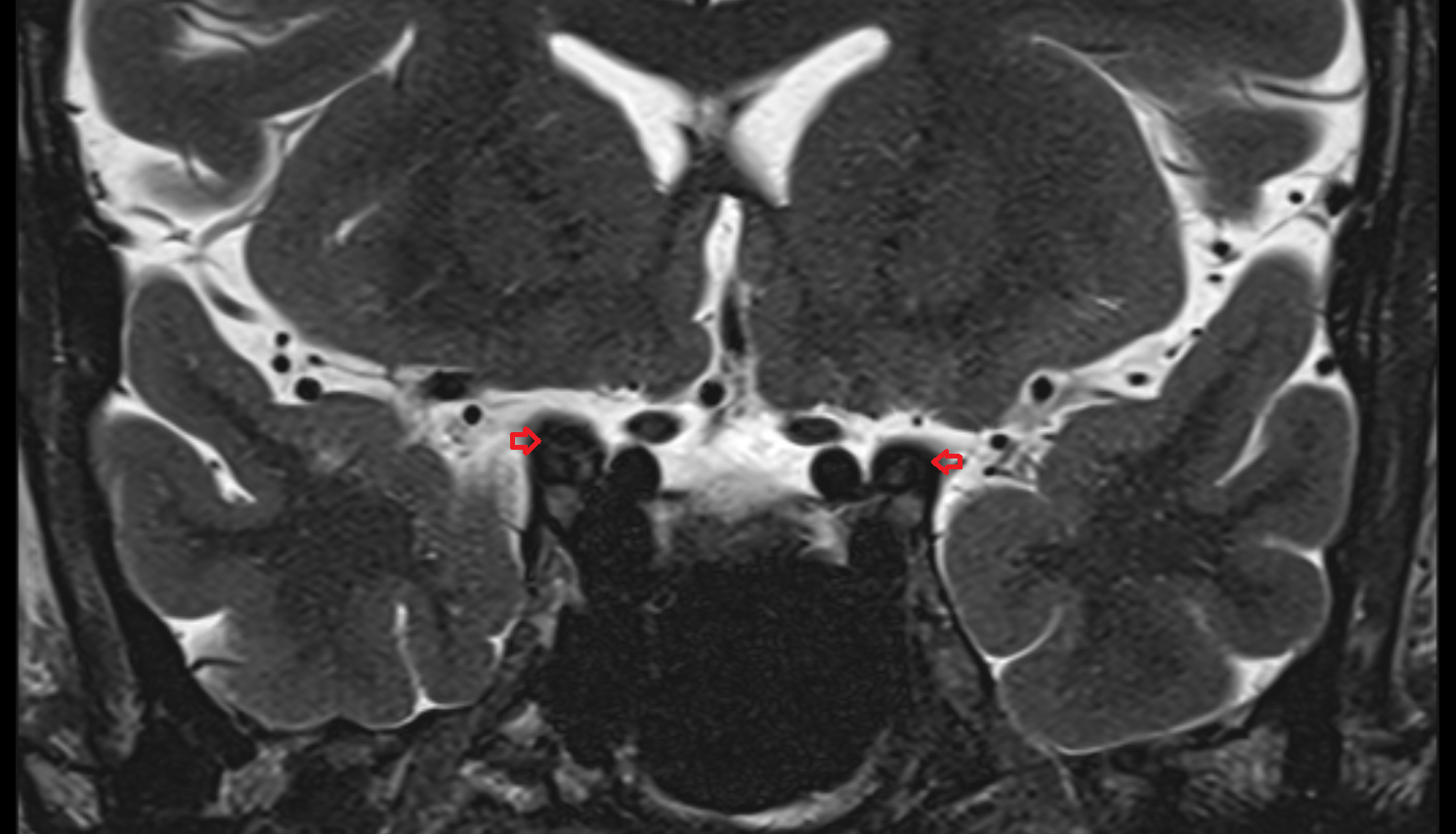 Anterior clinoid process MRI -img-00000-00000