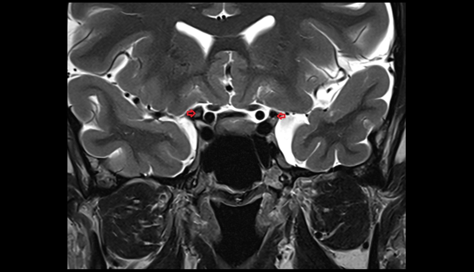 Anterior clinoid process MRI