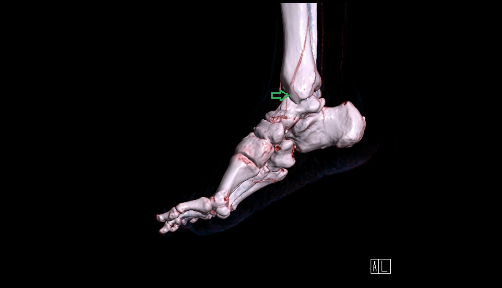 Anterior colliculus of medial malleolus 3d