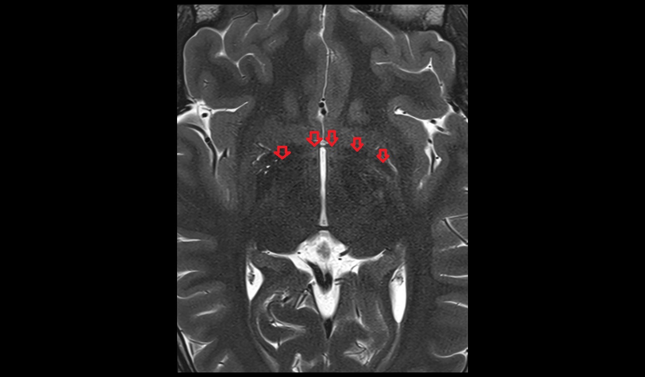 Anterior commissure mri 3t axial image