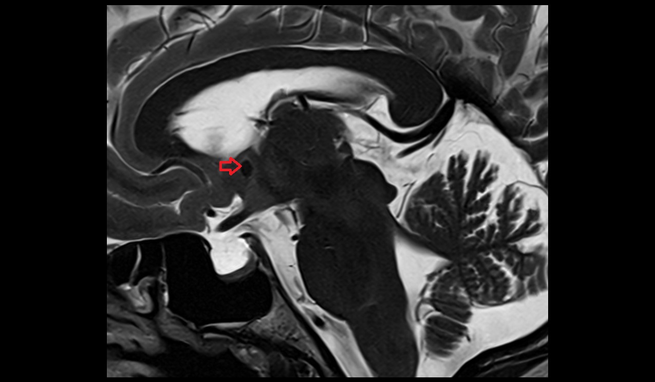 Anterior commissure mri 3t sagittal image