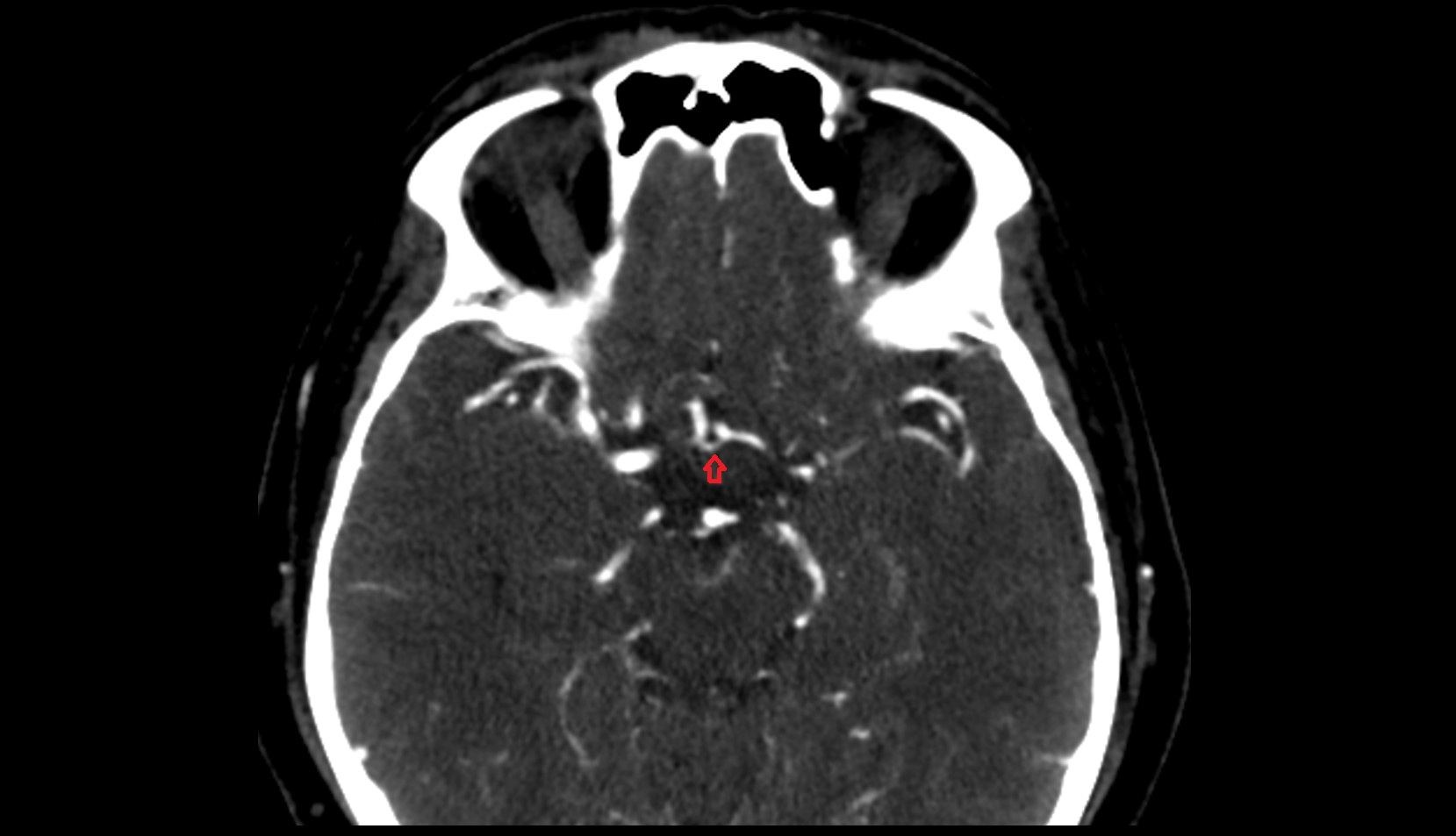 Anterior Communicating Artery (ACom) ct image