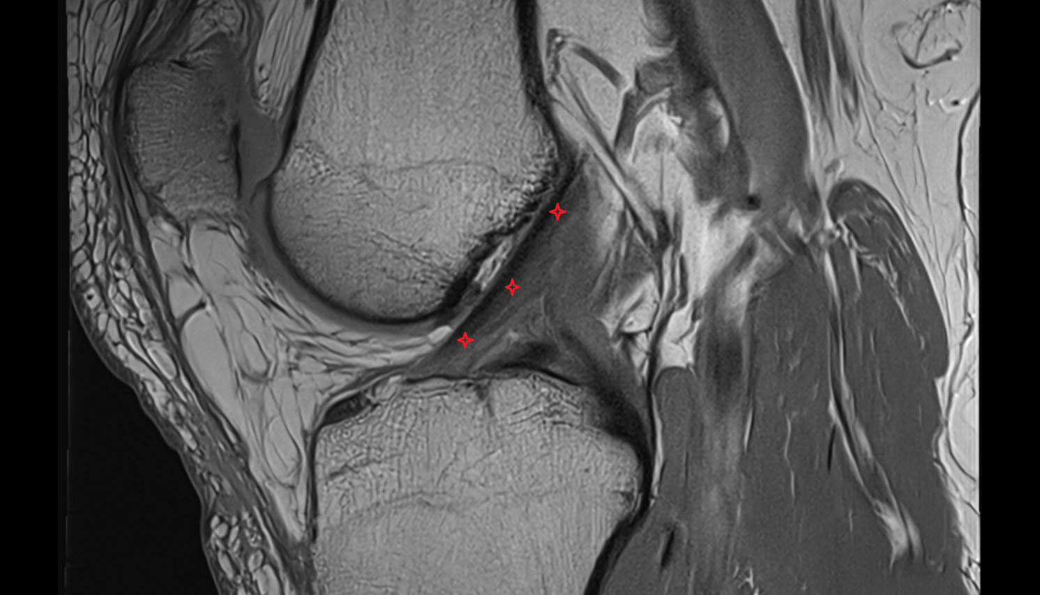 Anterior cruciate ligament (ACL) axial cross sectional anatomy 3T MRI AI enhanced  radiology  anatomy image-img-00000-00000_00001