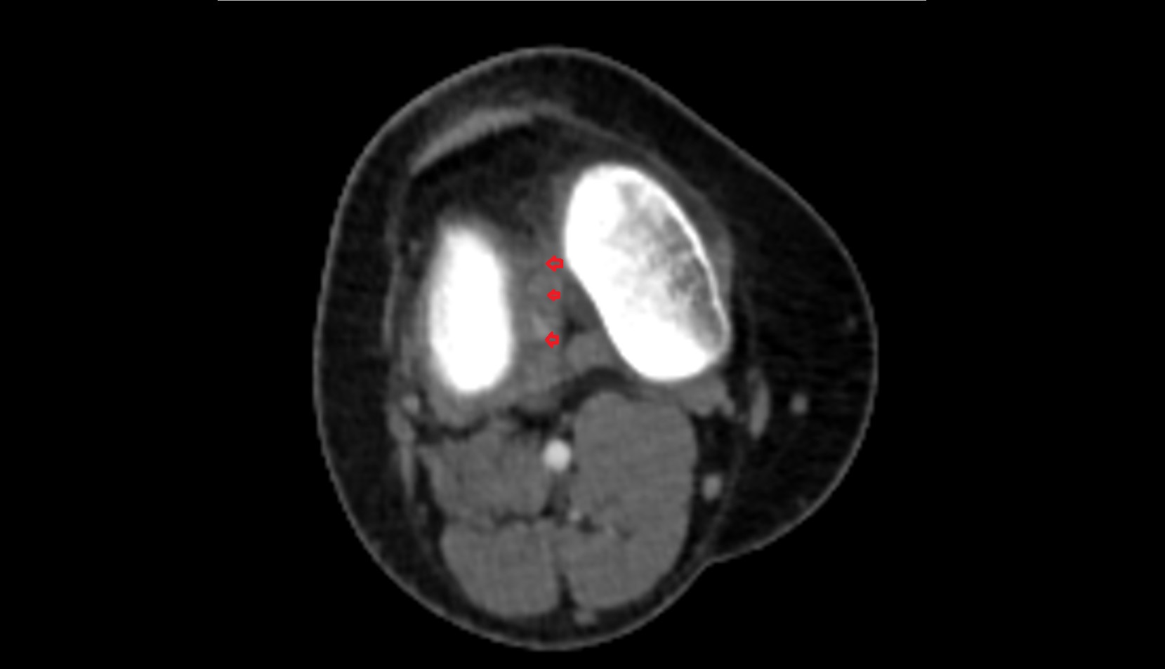 Anterior cruciate ligament (ACL) ct axial image