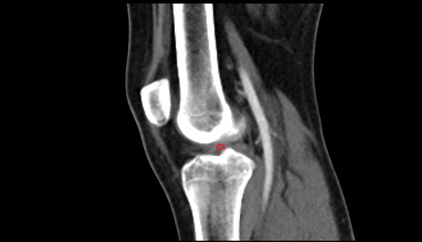 Anterior cruciate ligament (ACL) ct sagittal image