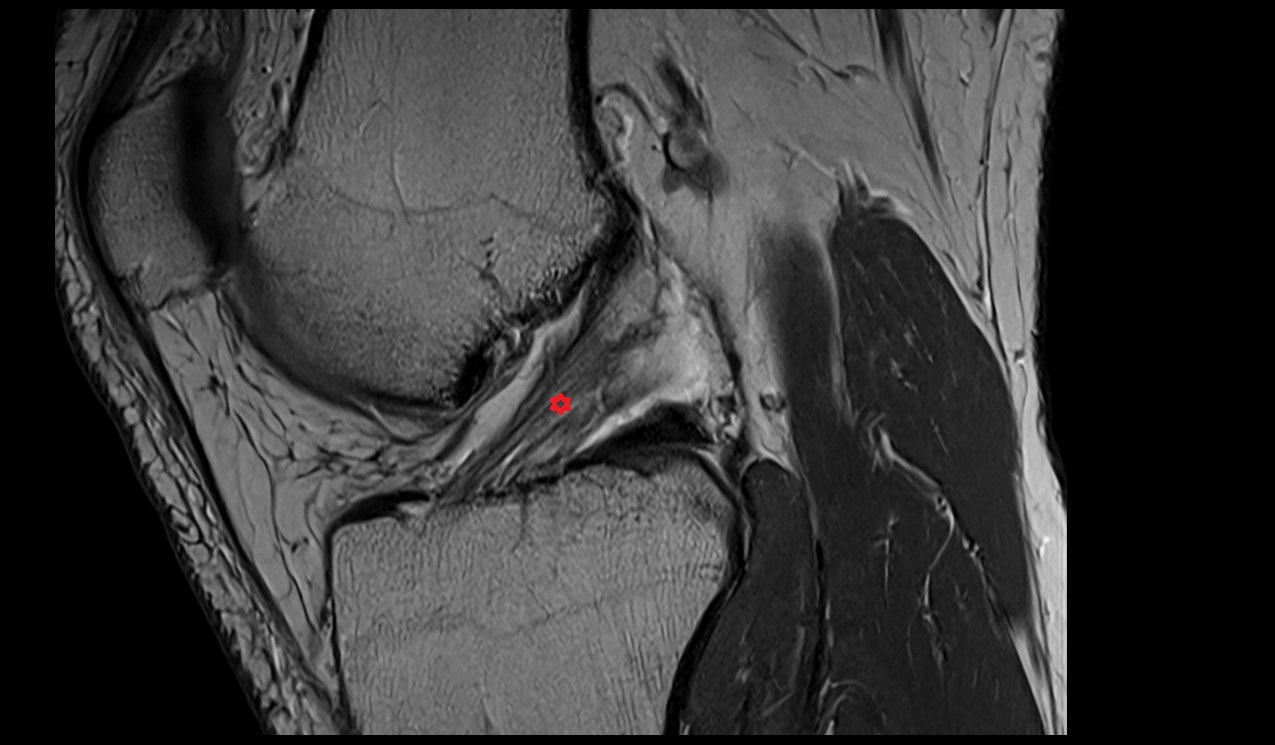 Anterior cruciate ligament anatomy image