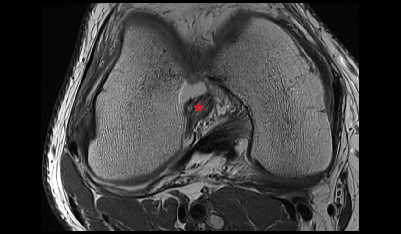 Anterior cruciate ligament anatomy image MRI 3T