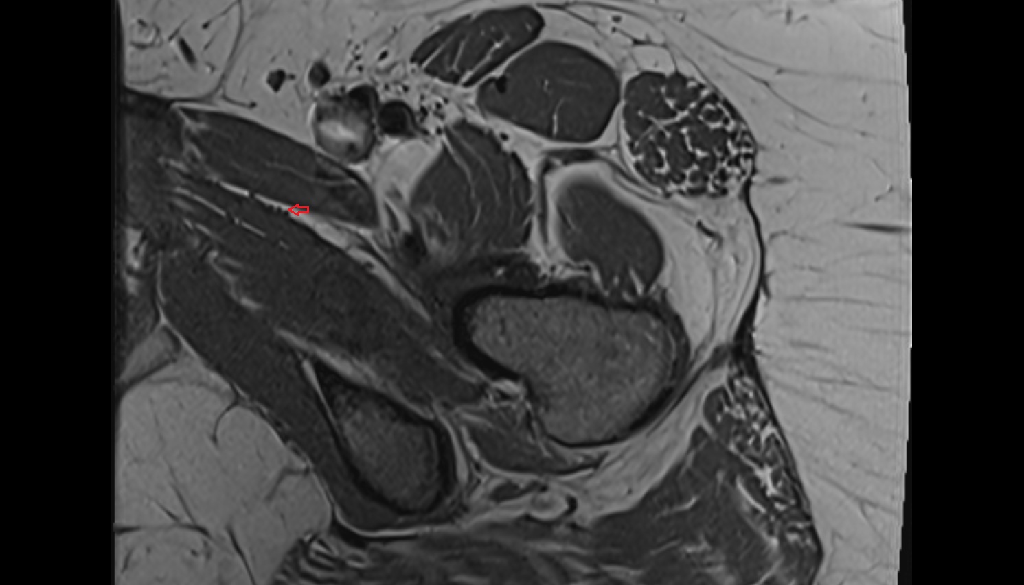 Anterior division of obturator nerve  MRI  axial  anatomy  image-img-00000-00000_00001