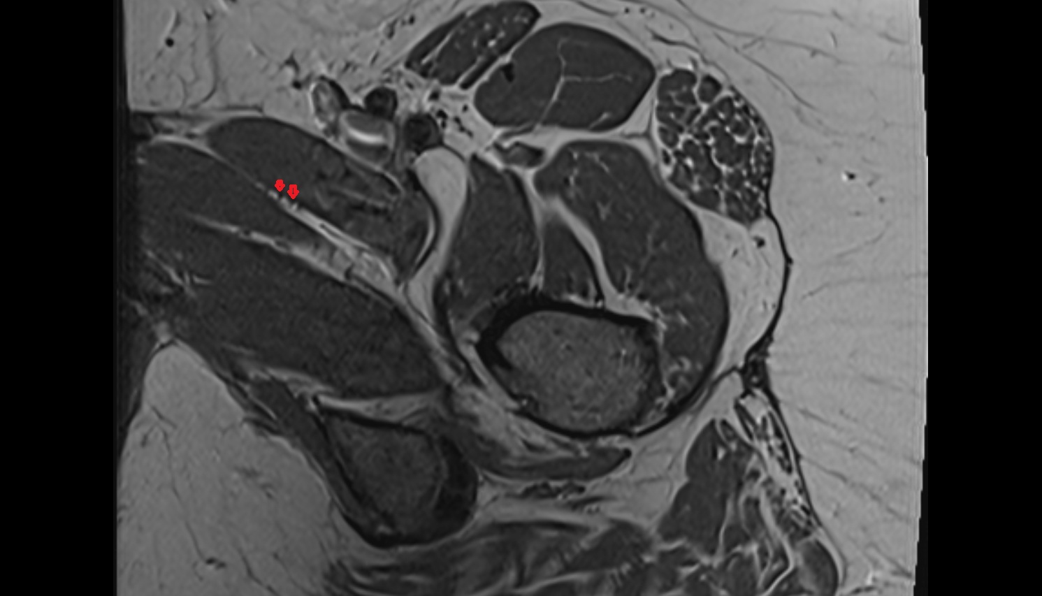 Anterior division of obturator nerve  MRI  axial  anatomy  image-img-00000-00000_00002