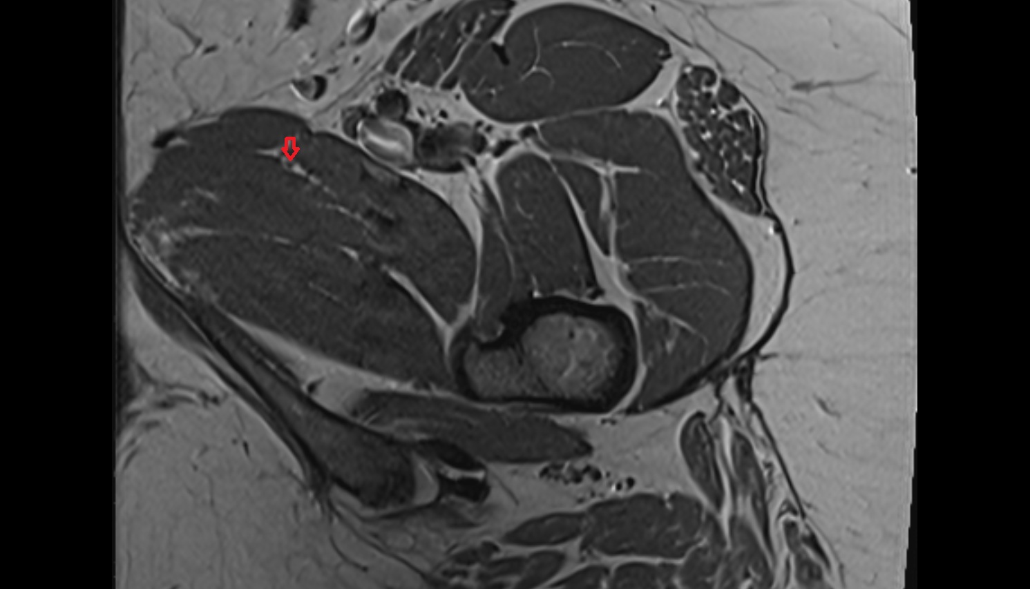 Anterior division of obturator nerve  MRI  axial  anatomy  image-img-00000-00000_00003