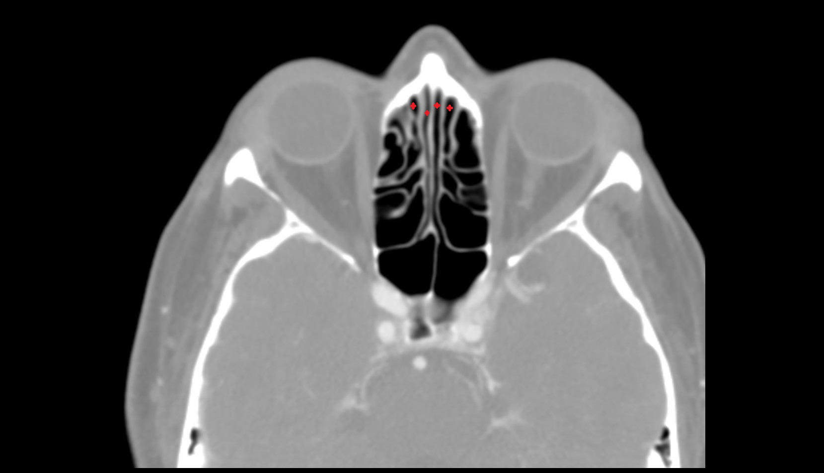 Anterior ethmoidal air cells ct axial