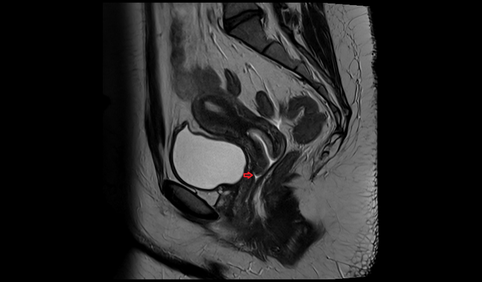 Anterior fornix of cervix